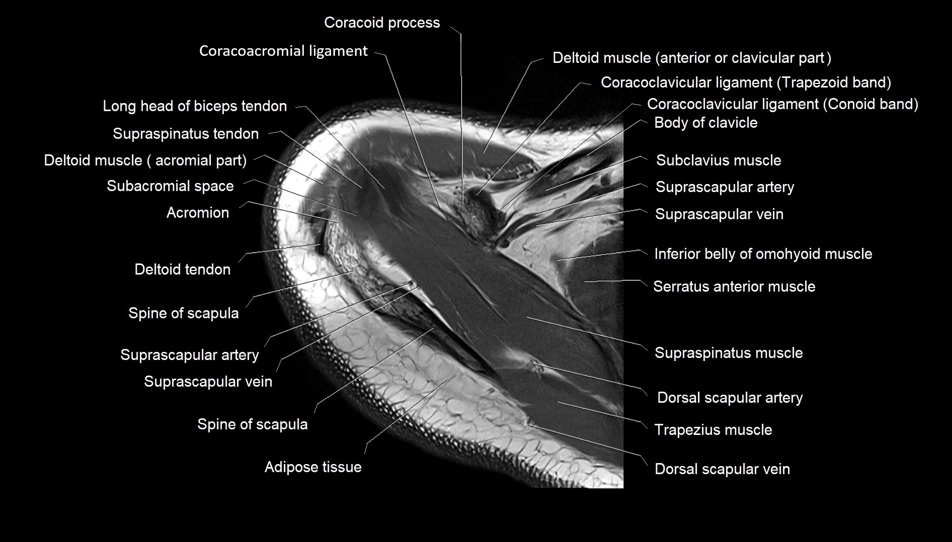 Shoulder cross sectional anatomy MRI 3T axial image 9.webp